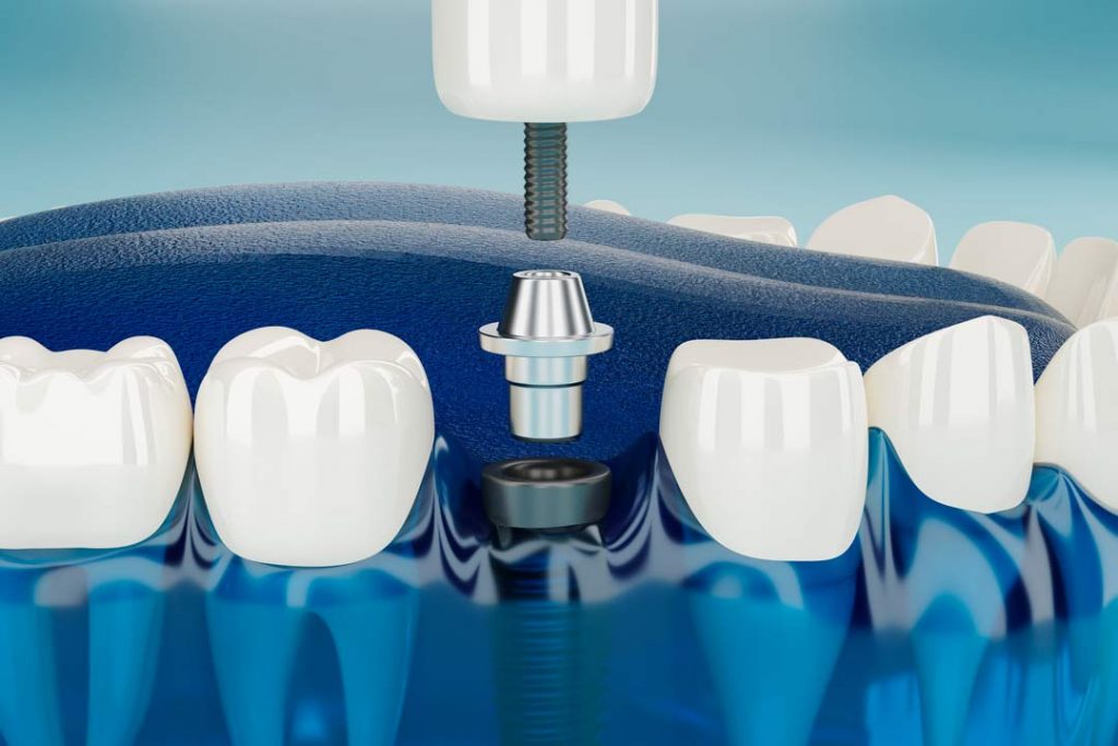 mejores implantes dentales sevilla