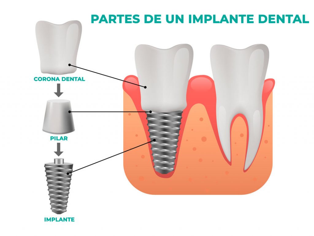 partes de un implante dental