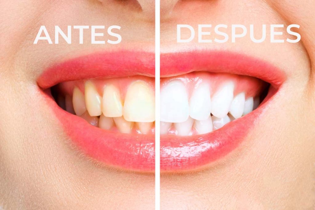 blanqueamiento dental prevdent