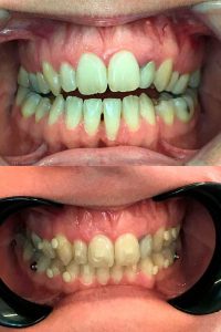 invisalign casos de exito