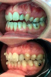 invisalign esther aparicio