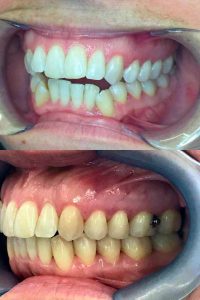 invisalign provider platinum