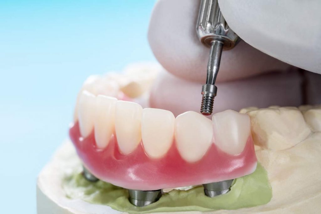reparacion protesis dentales rotas