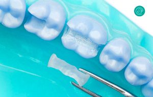 clinica dental esther aparicio incrustacion dental